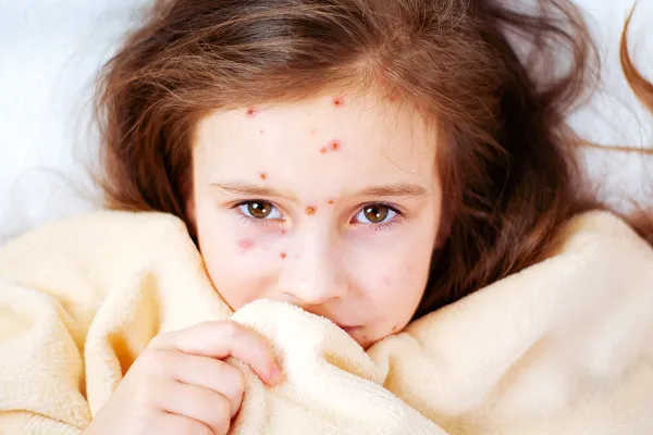 Neštovice: prodělat, nebo očkovat?